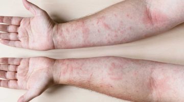 تجربتي مع التهاب المفاصل الصدفي