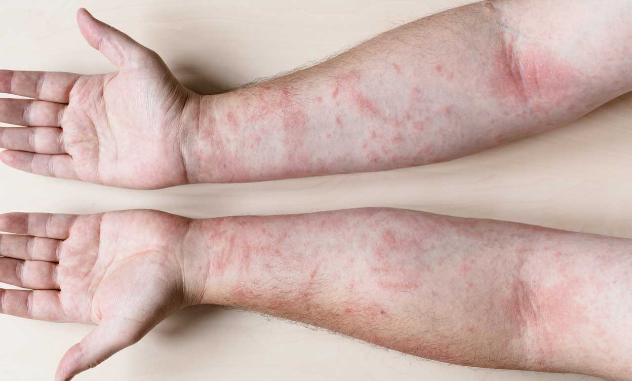 تجربتي مع التهاب المفاصل الصدفي