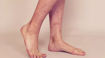 علاج البقع البنية في الساقين