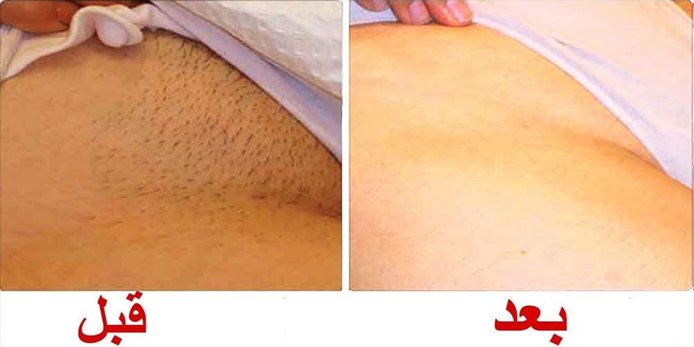 فوائد العكر الفاسي للمنطقة الحساسة