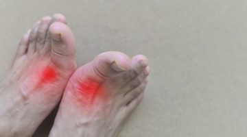 أعراض ارتفاع حمض البول وأسبابه وطرق الوقاية منه