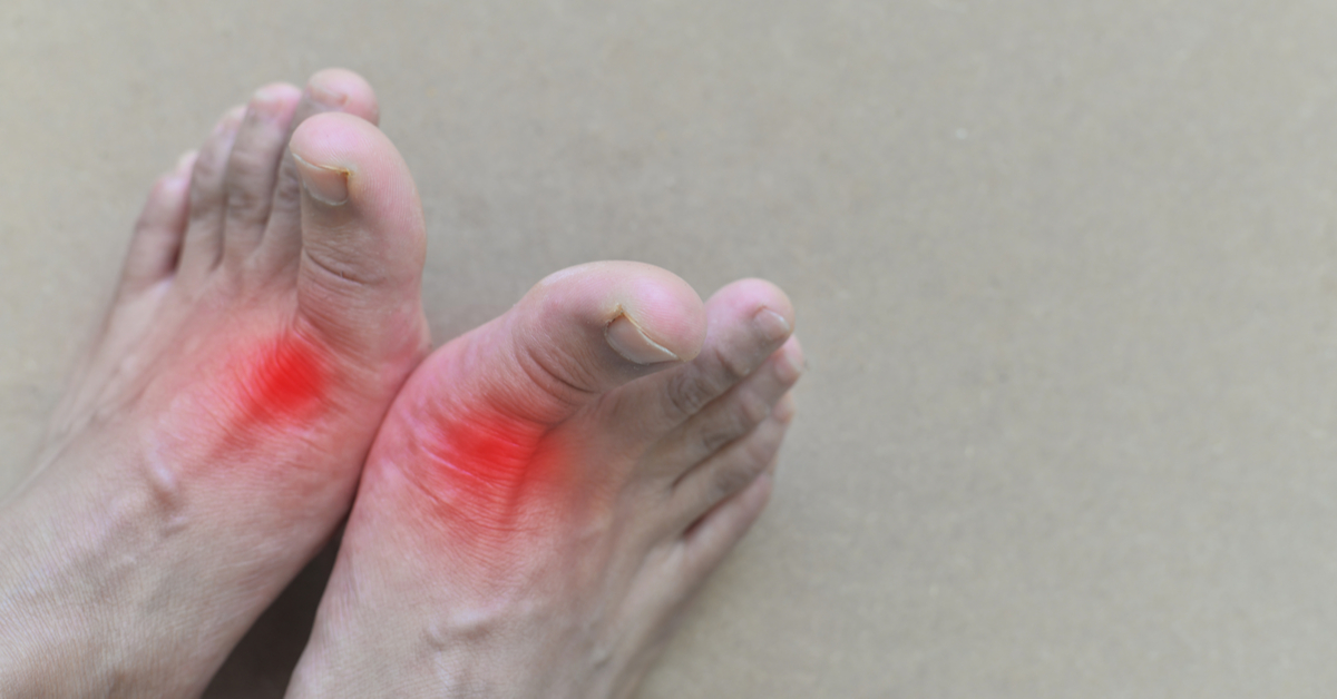 أعراض ارتفاع حمض البول وأسبابه وطرق الوقاية منه