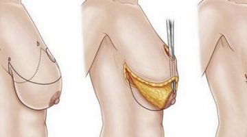 تصغير الثدي في أقل من أسبوع