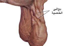 كيف تعلم أنك مصاب بدوالي الخصيتين