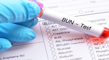 هل ارتفاع اليوريا يسبب الموت 