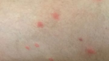 طفح الحفاظ على شكل حبوب