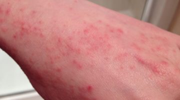 مشروبات لعلاج الحساسية الجلدية