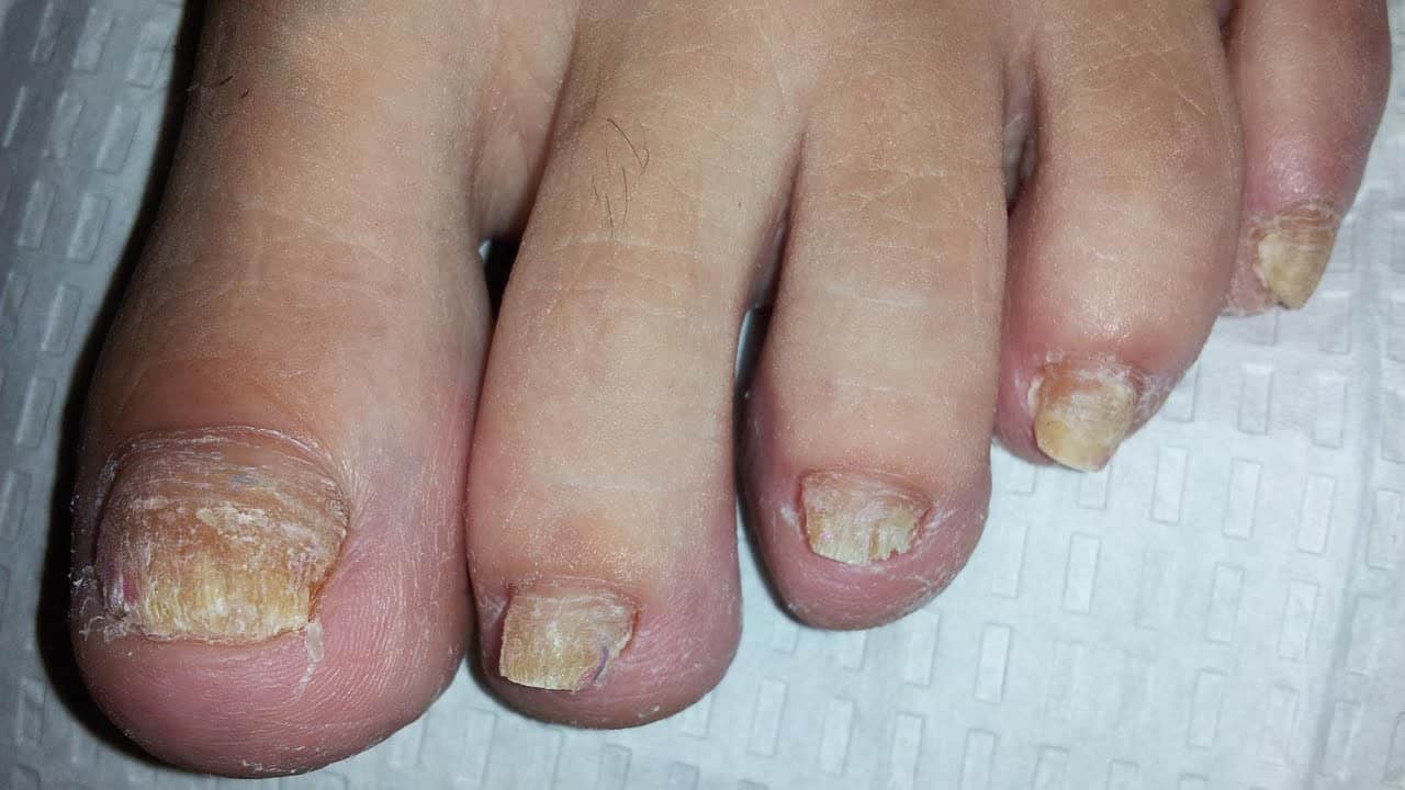 علاج فطريات الأظافر بالخل