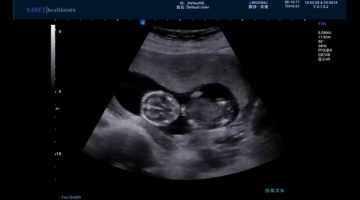 هل الزائدة تظهر في السونار