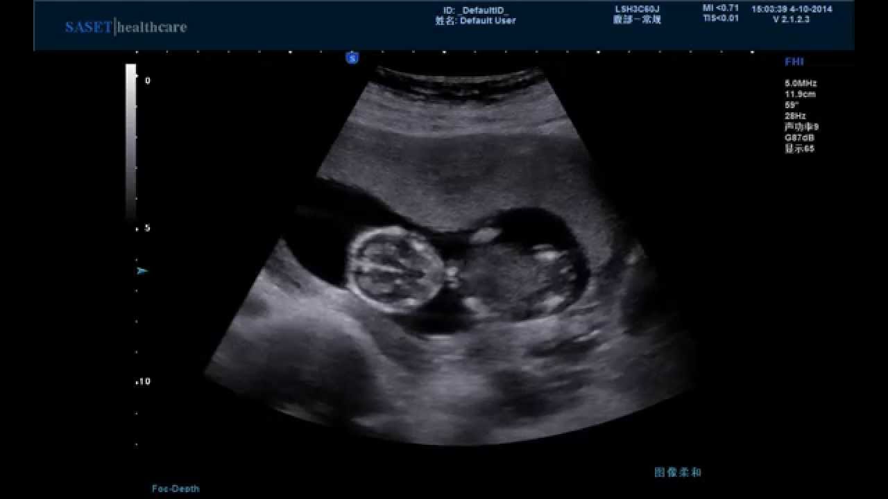 هل الزائدة تظهر في السونار