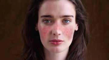 ما هو مرض الذئبة الحمراء