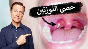 تجربتي مع حصوات اللوز