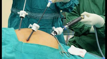 فقدان الشهية بعد عملية الزائدة