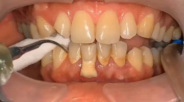 تنظيف الأسنان من الجير بالطرق المنزلية