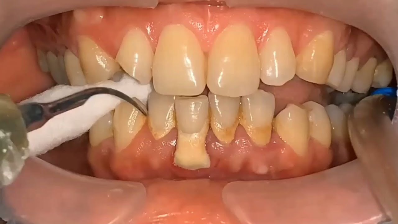 تنظيف الأسنان من الجير بالطرق المنزلية