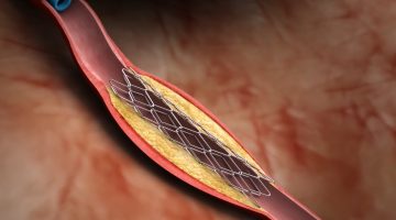 علاج انسداد شرايين القلب بدون جراحه
