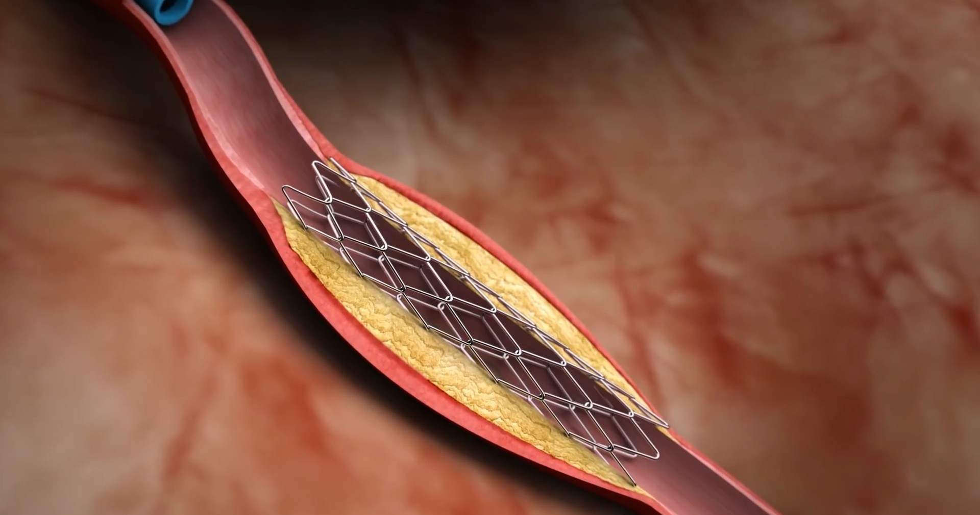 علاج انسداد شرايين القلب بدون جراحه