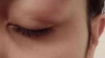 علاج انتفاخ جفن العين السفلي