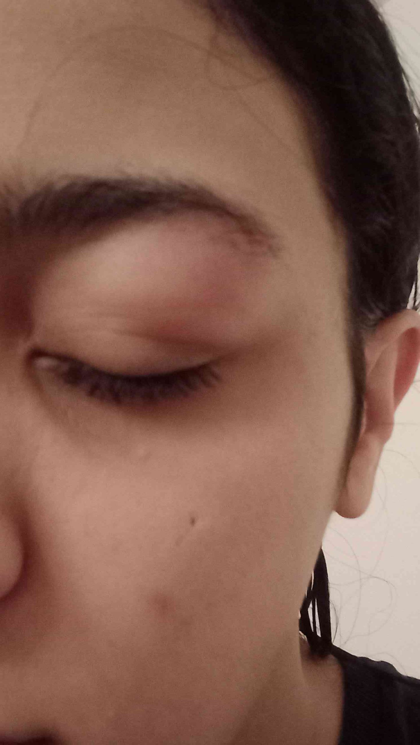 علاج انتفاخ جفن العين السفلي