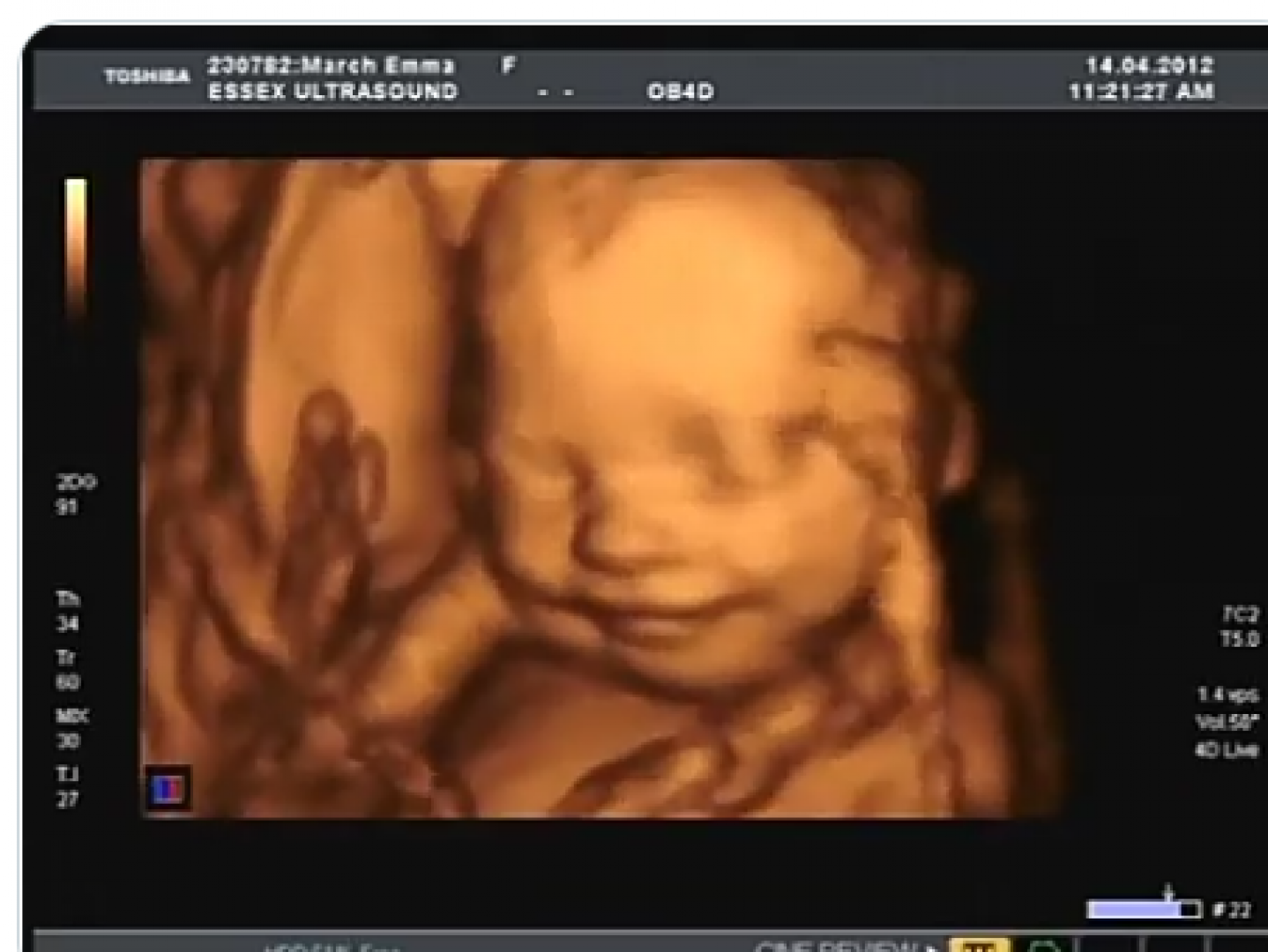 هل حركة الجنين الذكر نفضه