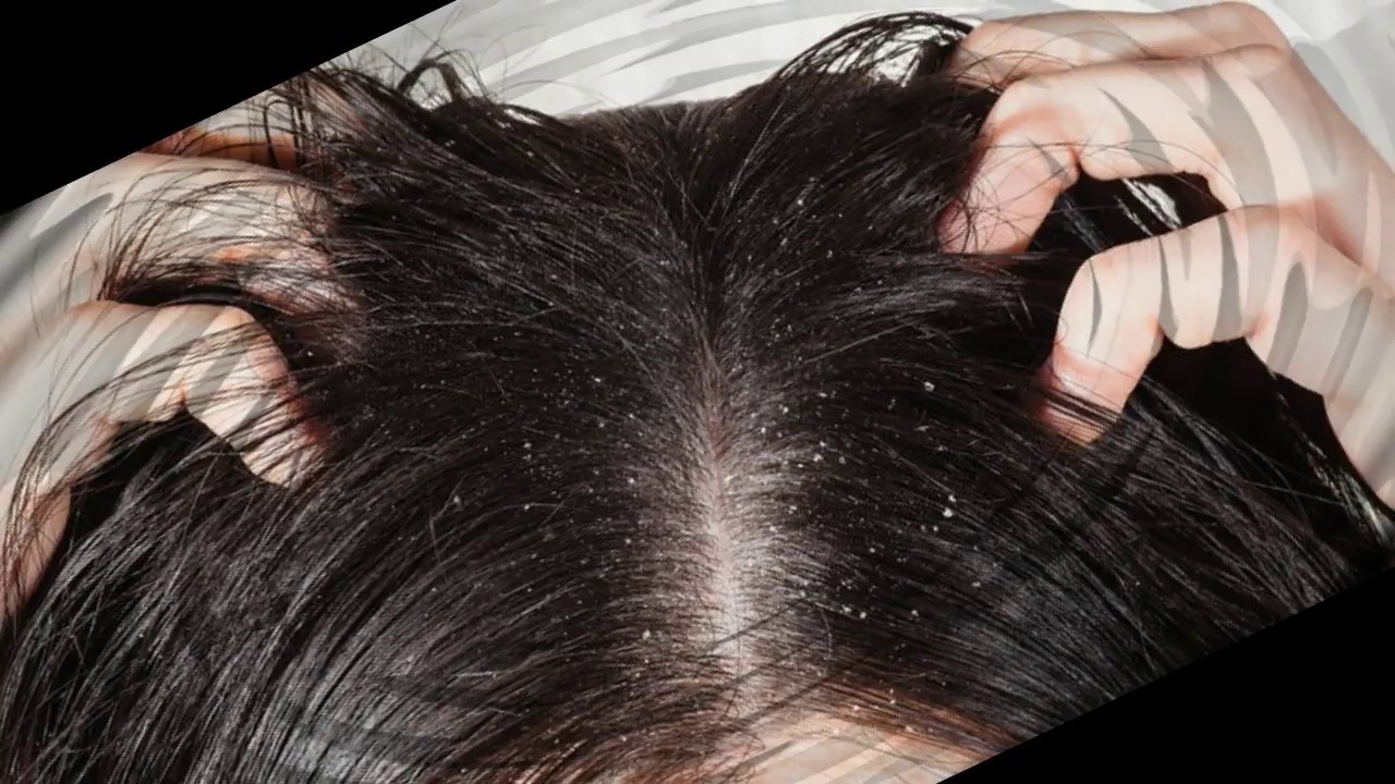 علاج ألم أعلى الرأس وليس صداع