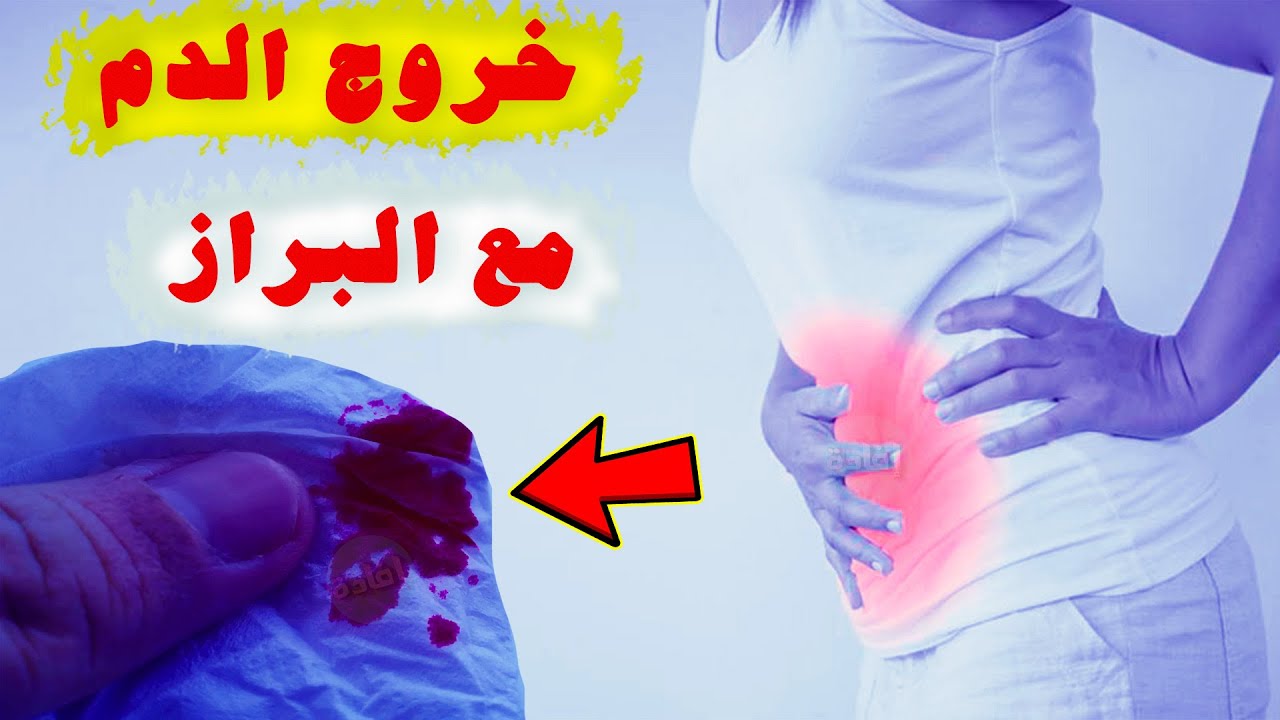 علاج خروج الدم مع البراز بالاعشاب