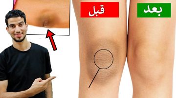 علاج حروق الركب بعد التقشير