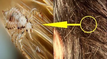 هل يموت القمل بالسيشوار