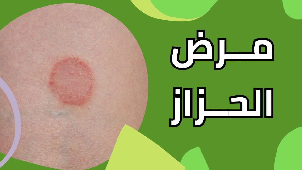 هل الحزاز مرض خطير