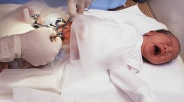 شكل الختان الصحيح للذكور