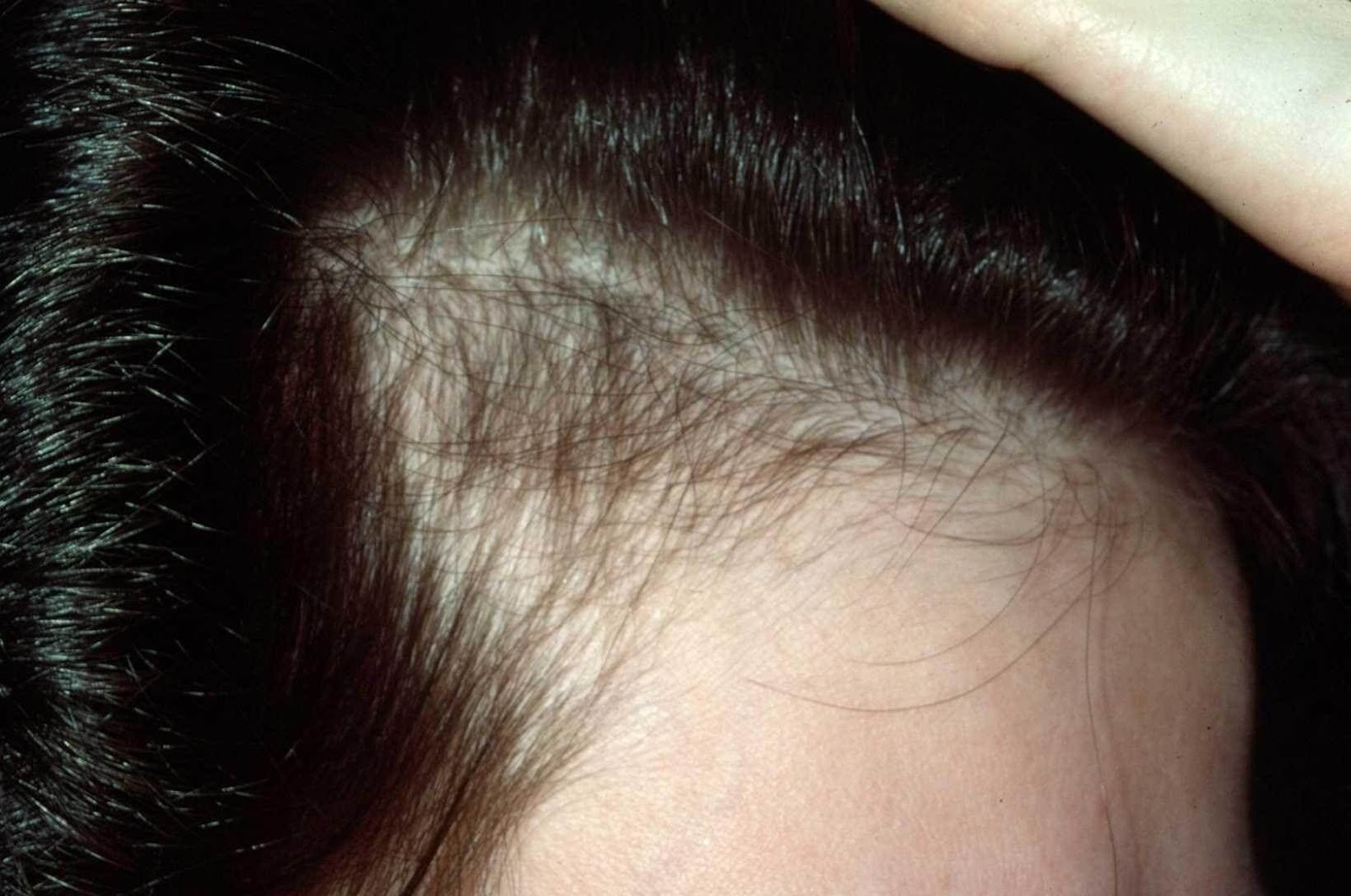 أسباب تساقط الشعر عند الشباب