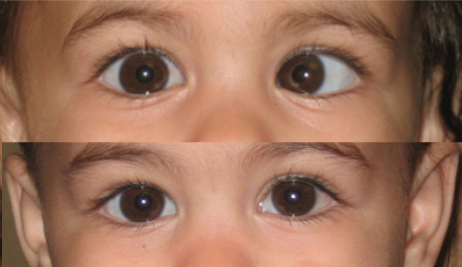 الفرق بين الحول والحور في العين