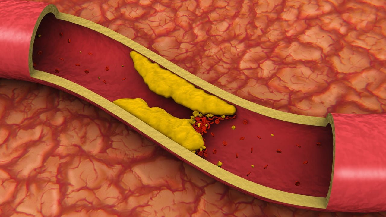 تخفيض الكوليسترول في 30 يوما