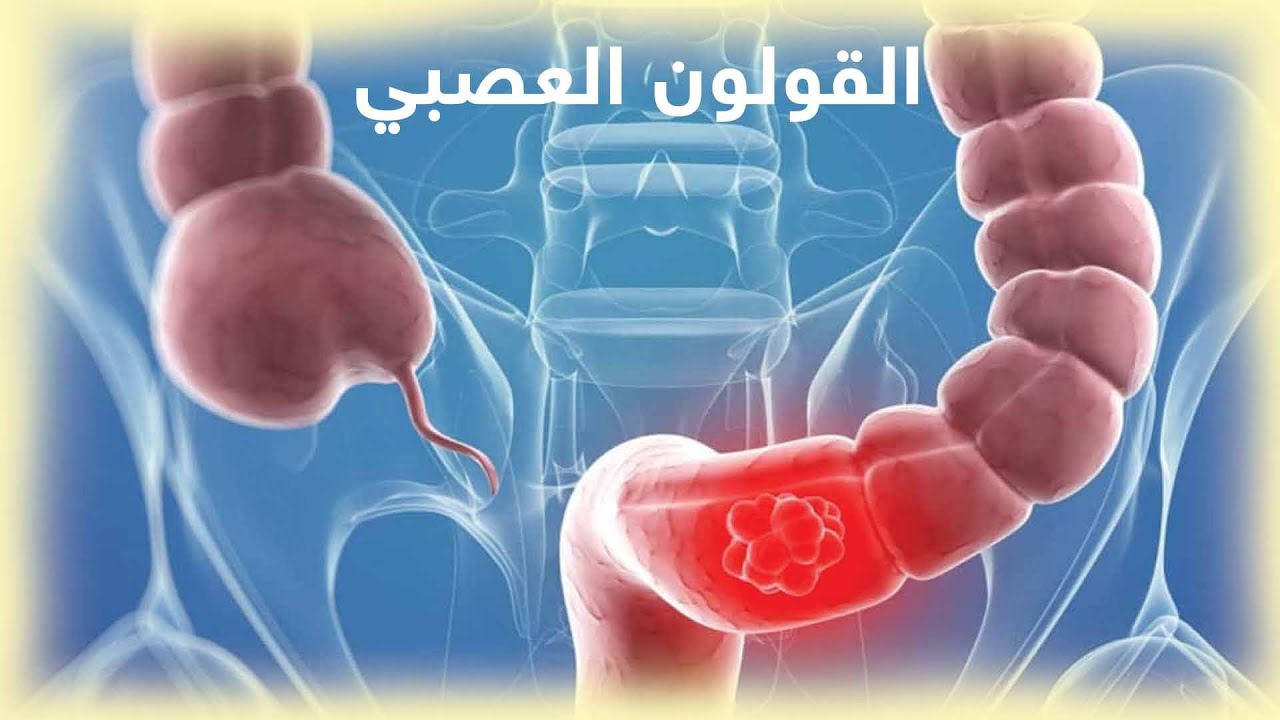 شفيت من القولون العصبي بالرقية