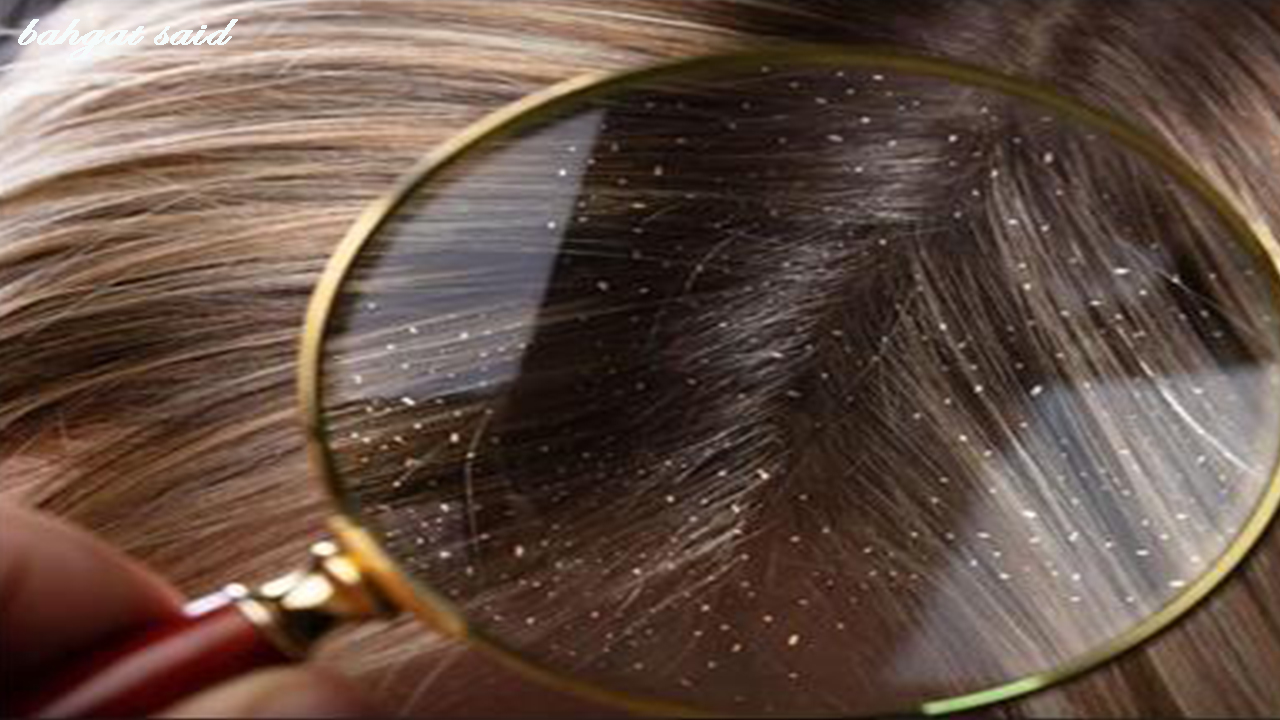 علاج قشرة الشعر الجاف