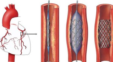 الآثار الجانبية بعد عملية القسطرة