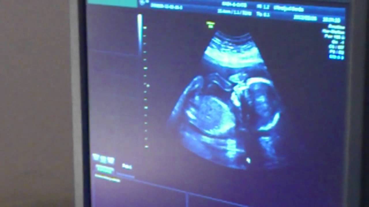 حلمت اني عملت سونار وطلعت حامل ببنت للحامل 