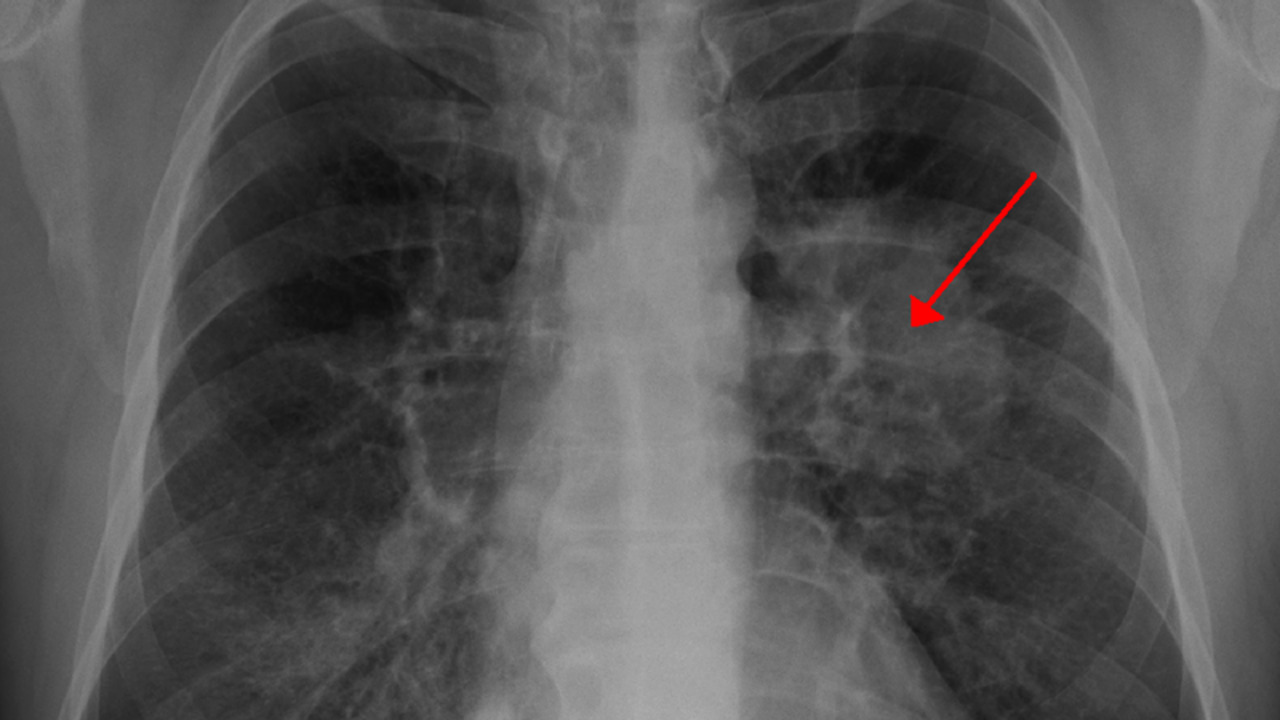 هل يشفى مريض سرطان الرئة