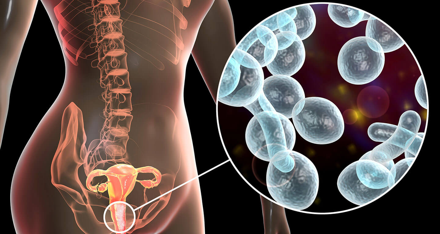 الفرق بين التهاب المهبل البكتيري والفطري