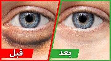 علاج الكدمات السوداء حول العين