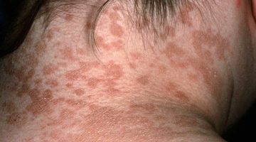 الفرق بين البهاق والفطريات