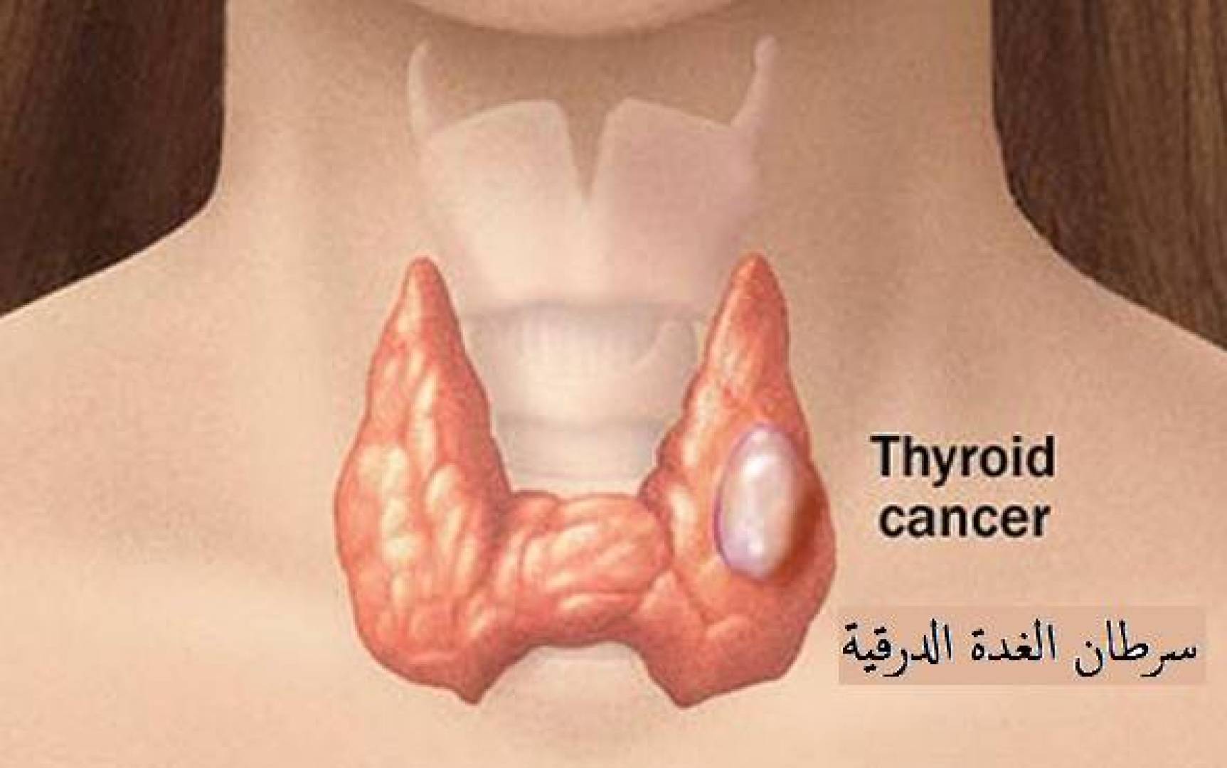 علاج الغدة الدرقية بالماء الساخن