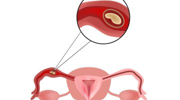 متى أحمل بعد عملية حمل خارج الرحم